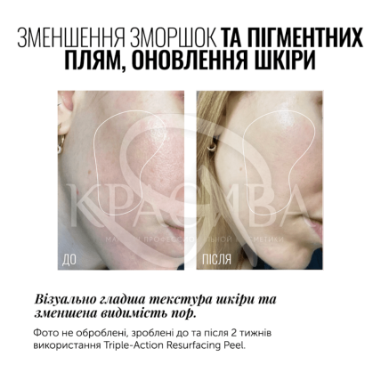Пілінг для обличчя - 2