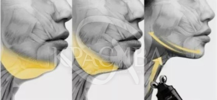 Роликовый крем по уходу за эластичностью кожи - 2